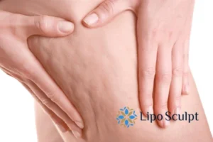 CoolSculpting for Legs: The Innovative Approach to Redefining Your Legs 5 Start your journey today book your coolsculpting treatment Eton online today!