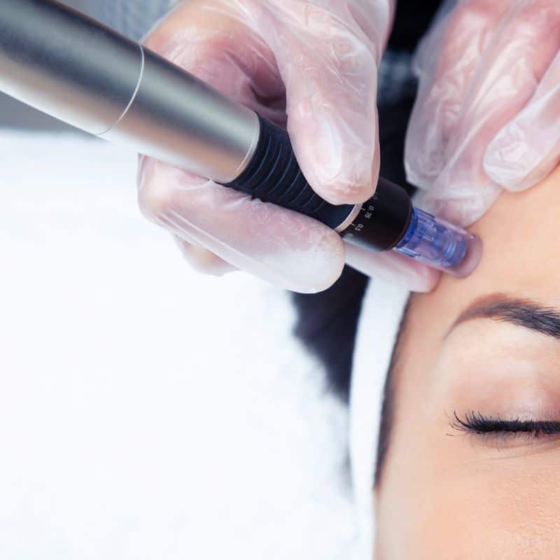 Morpheus8 treatment Eton from Lipo Sculpt - Book in today!