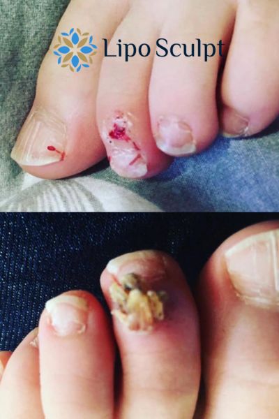 Wart removal customer results from Lipo Sculpt Eton