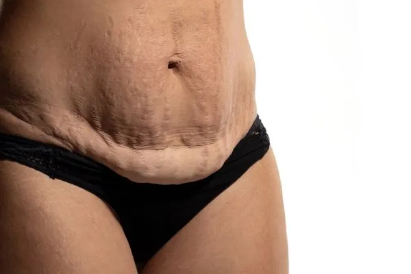 Lost the Weight but Not the Loose Skin? 1 image of womans stomach after weight loss showing loose skin Eton